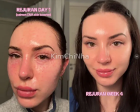 Tiêm Rejuran tại Hàn Quốc: Công nghệ trẻ hóa da bằng DNA cá hồi gây sốt toàn cầu