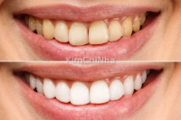 Thứ đang biến miệng bạn thành ổ vi khuẩn và... một bãi rác