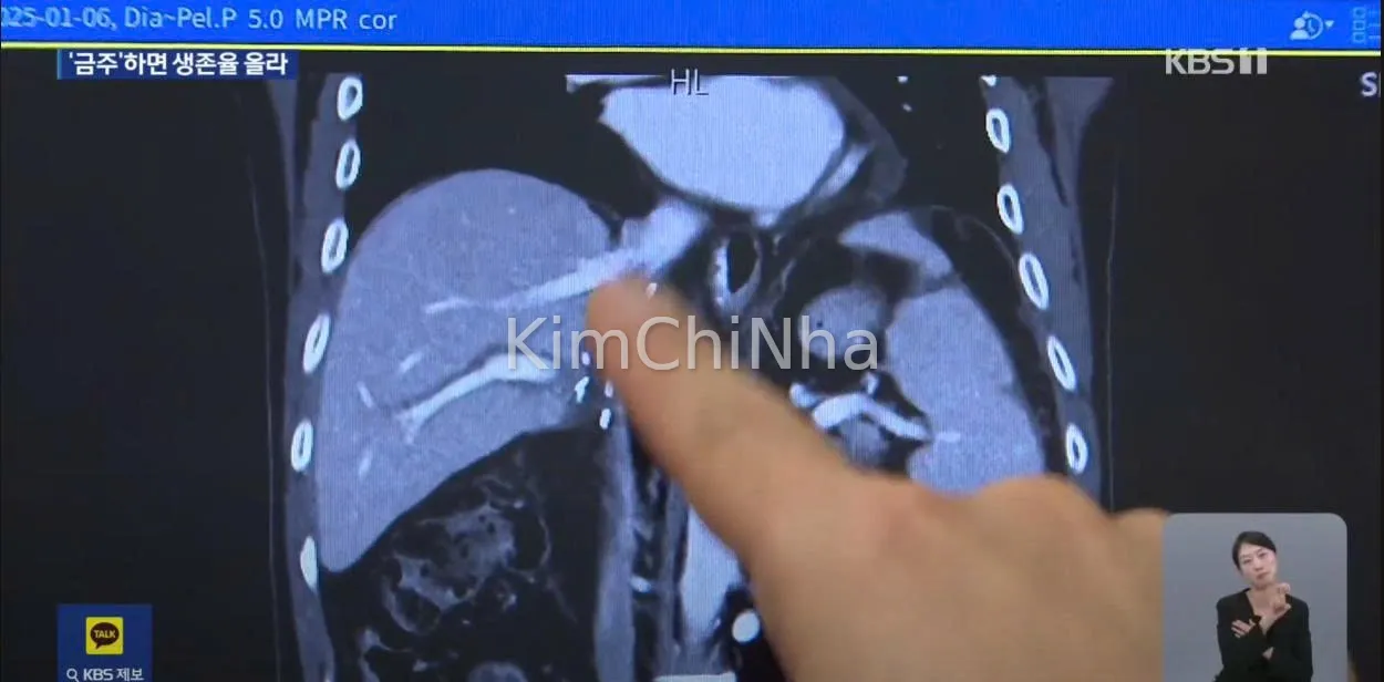 Bỏ rượu không chỉ là quyết tâm đầu năm: Tỷ lệ sống sót của bệnh nhân ung thư gan phụ thuộc vào việc “cai rượu” hoàn toàn